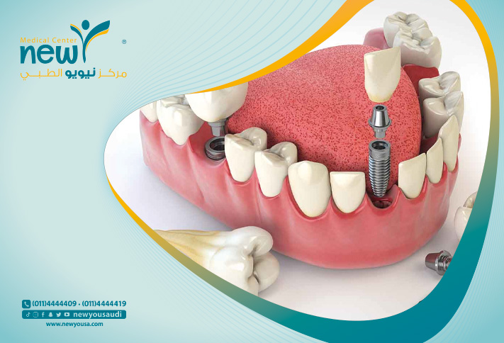 جراحة زراعة الاسنان تعرف عليه من خلال مركزنا الطبي في السعودية | نيويو