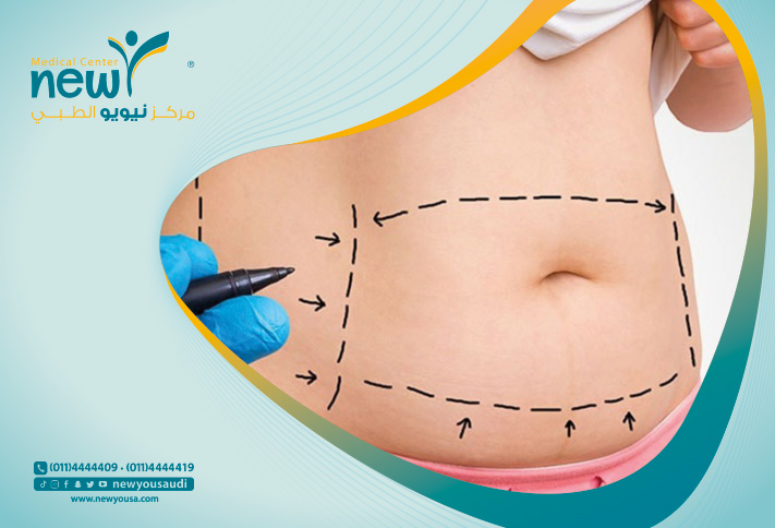 مركز نيويو الطبي من أهم المراكز في عمليات جراحة شد البطن في السعودية