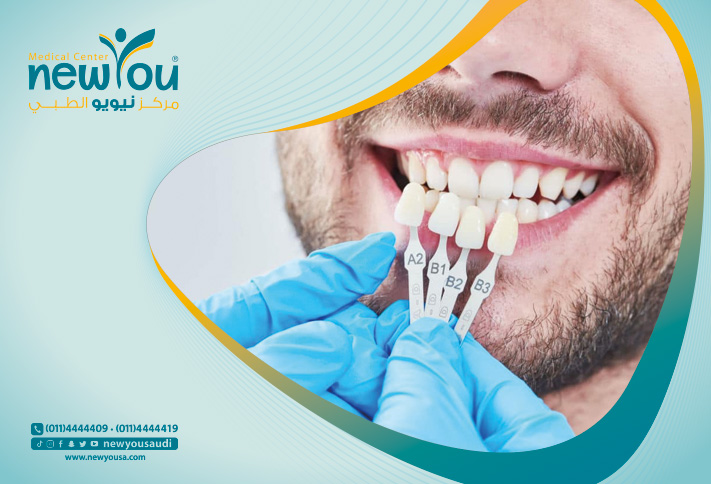 تلبيس الأسنان تعرف عليه من خلال مركزنا الطبي في السعودية | نيويو