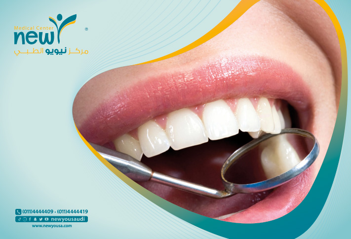 قشور الاسنان كل ما تريد معرفته عنها من خلال مركزنا الطبي في السعودية | نيويو