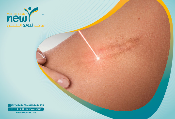 علاج التصبغات الجلدية تعرف عليه من خلال مركزنا الطبي في السعودية | نيويو