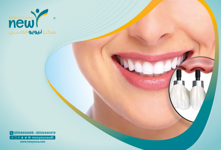 زراعة الأسنان تعرف عليه من خلال مركزنا الطبي في السعودية | نيويو