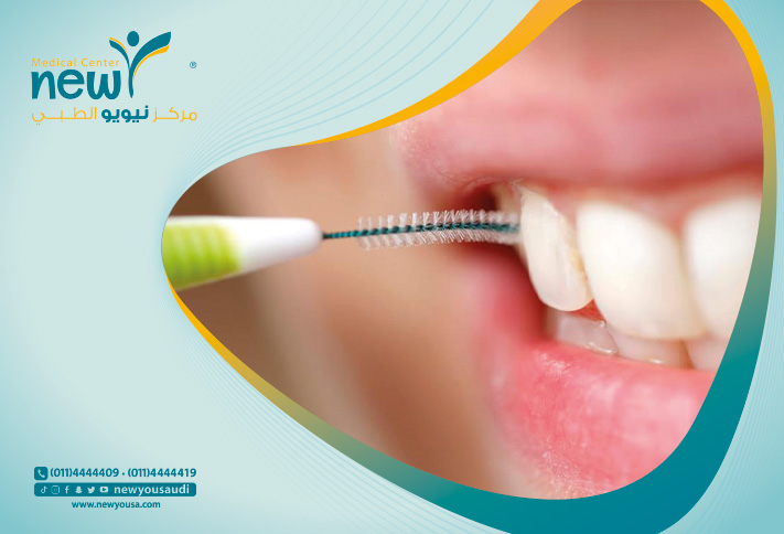 إزالة جير الأسنان تعرف عليه من خلال مركزنا الطبي في السعودية | نيويو