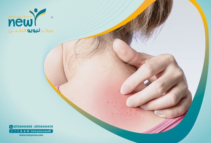 أمراض الجلد الشائعة كل ما تريد معرفته عنها من خلال مركزنا الطبي في السعودية | نيويو