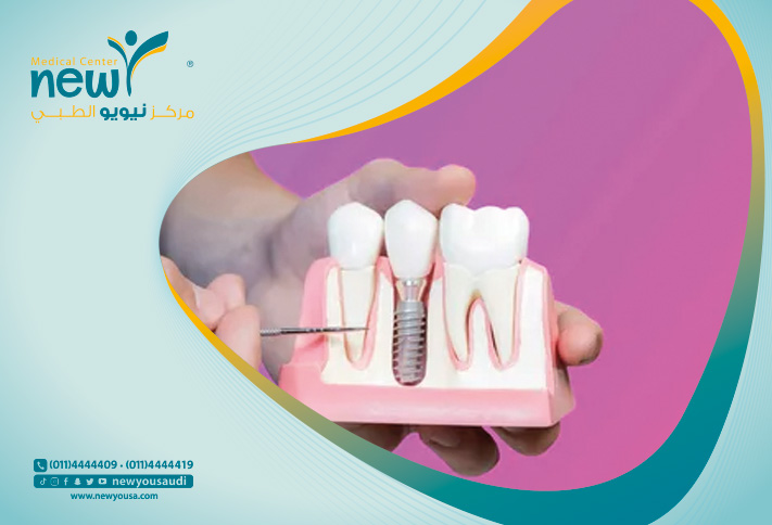 ألم زراعة الأسنان تعرف عليه من خلال مركزنا الطبي في السعودية | نيويو
