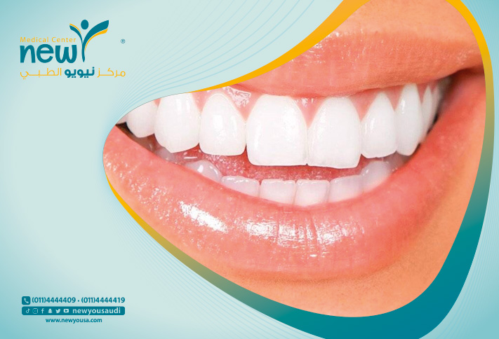 قوالب تبييض الاسنان كل ما تريد معرفته عنها من خلال مركزنا الطبي في السعودية | نيويو