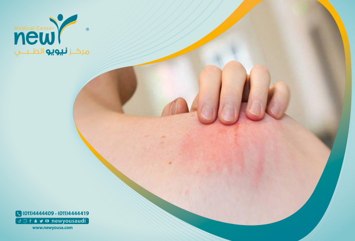 أمراض جلدية شائعة تعرف عليه من خلال مركزنا الطبي في السعودية | نيويو