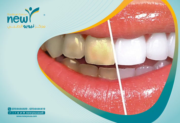 تبييض الأسنان  كل ما تريد معرفته عنه من خلال مركزنا الطبي في السعودية | نيويو