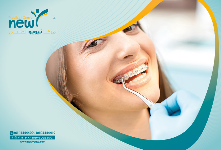 تقويم الأسنان  تعرف عليه من خلال مركزنا الطبي في السعودية | نيويو