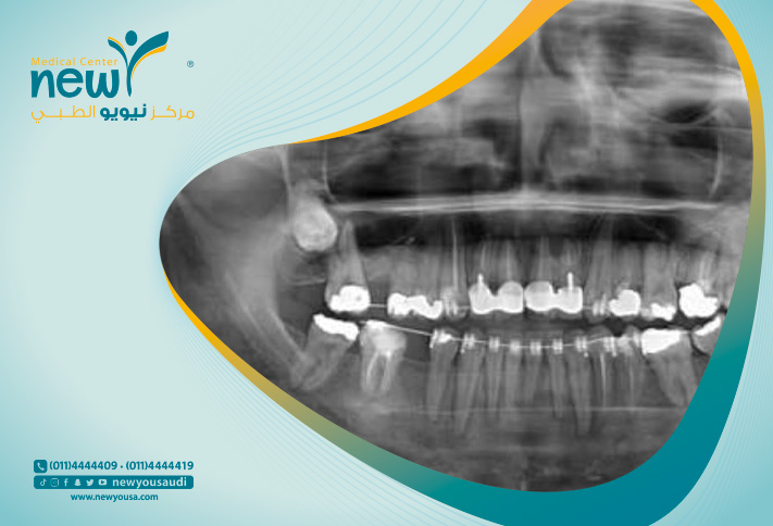 اسعار اشعة بانوراما اسنان في السعودية بأحدث التقنيات -مركز نيويو الطبي