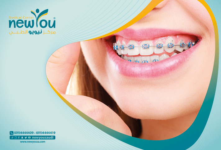 تقويم الأسنان تعرف عليه من خلال مركزنا الطبي في السعودية | نيويو