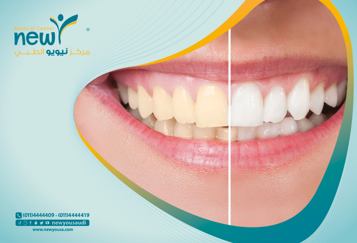 اسباب تسوس الاسنان رغم تنظيفها تعرف عليها من خلال مركزنا الطبي في السعودية | نيويو