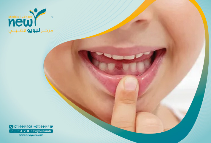 الأسنان اللبنية تعرف عليه من خلال مركزنا الطبي في السعودية | نيويو