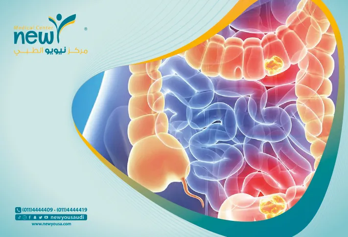 أمراض الامعاء الالتهابية